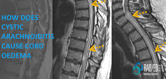 mri cystic arachnoiditis cord compression oedema radiology education asia