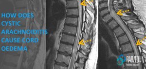 mri cystic arachnoiditis cord compression oedema radiology education asia