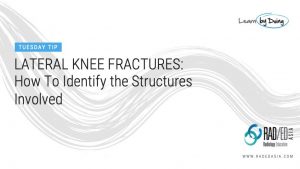 arcuate segond fracture fibular styloid radiology education asia tuesday tip