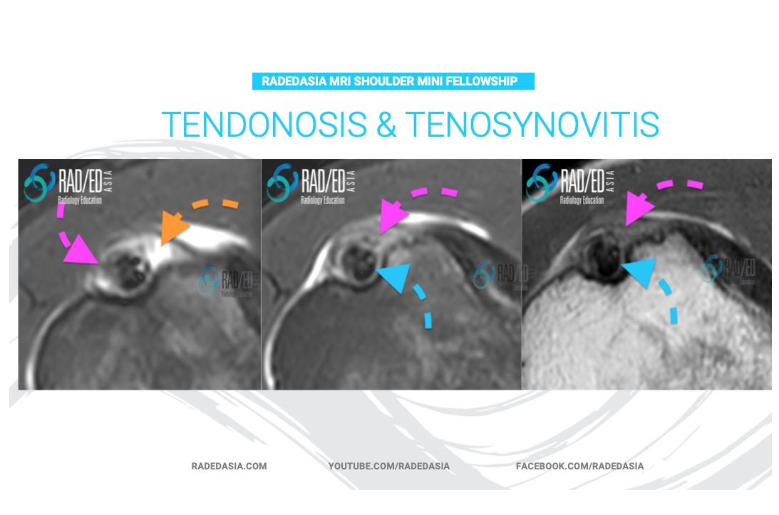 biceps tendon mri tendonosis tenosynovitis