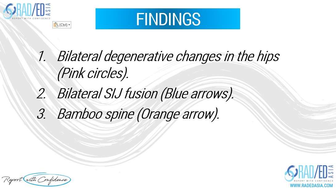 ankylosing spondylitis hip involvement imaging xray findings radedasia