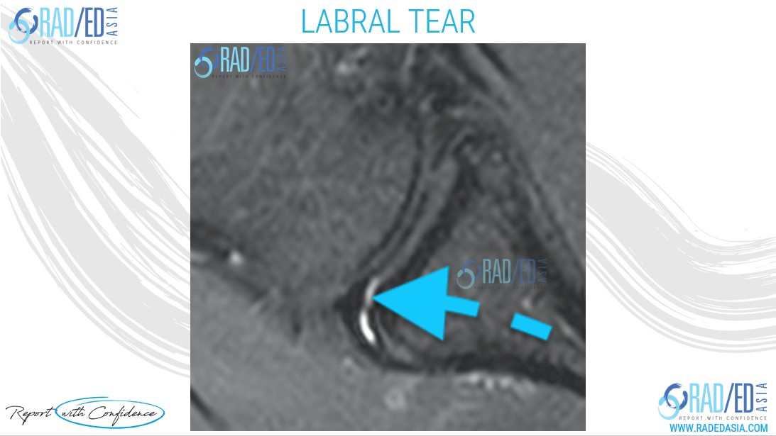 mri shoulder labral tear radedasia