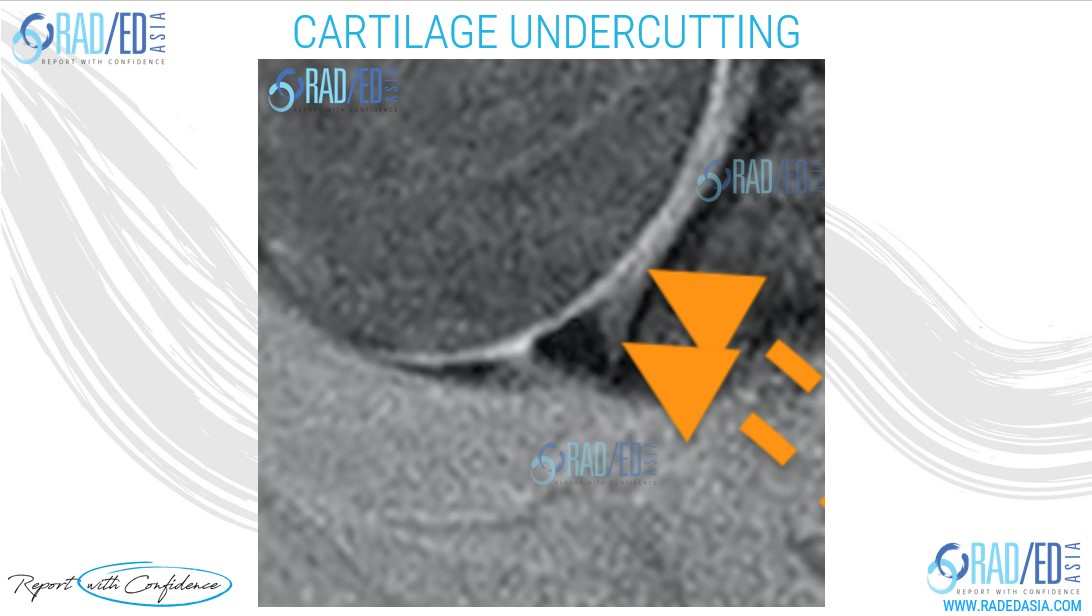 mri shoulder labrum cartilage undercutting radedasia