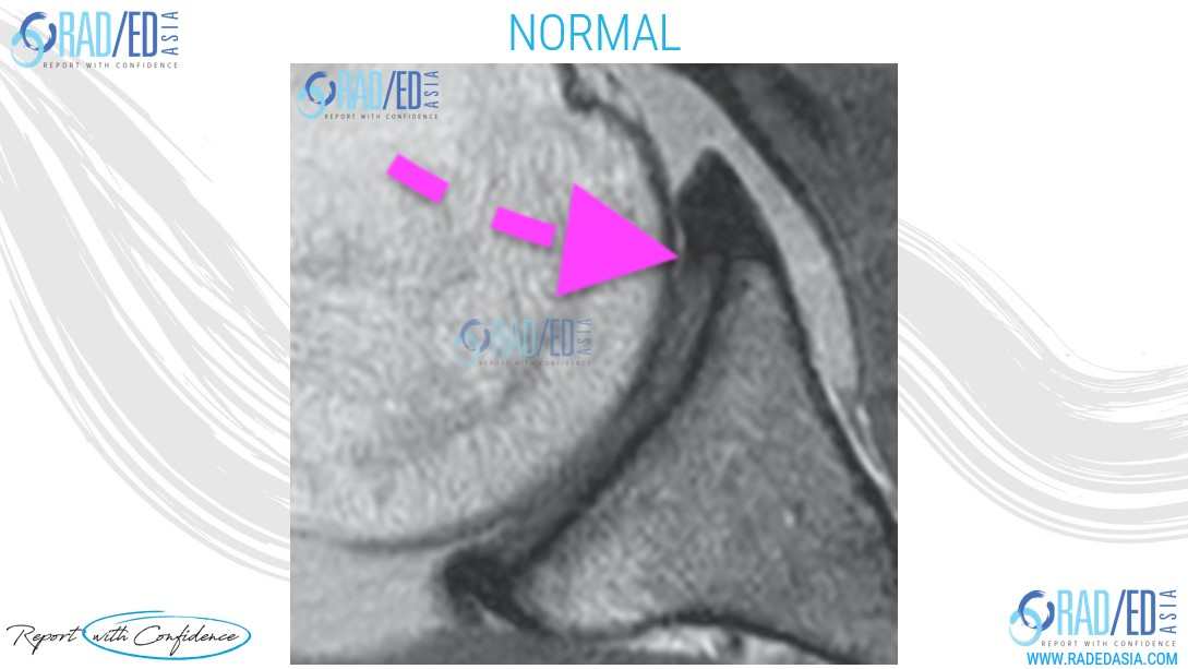 mri shoulder labrum normal radedasia