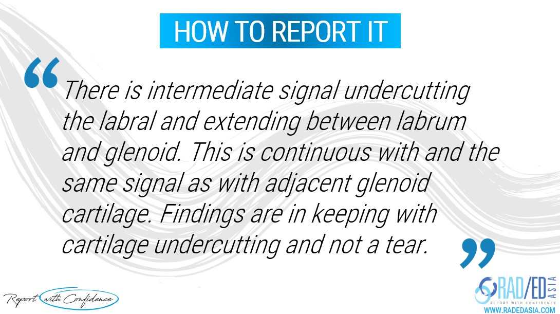 mri shoulder labrum undercutting report radedasia