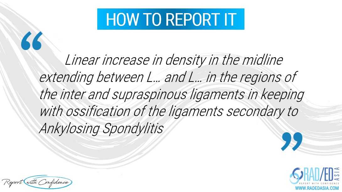 ankylosing spondylitis report radiology xray ct mri