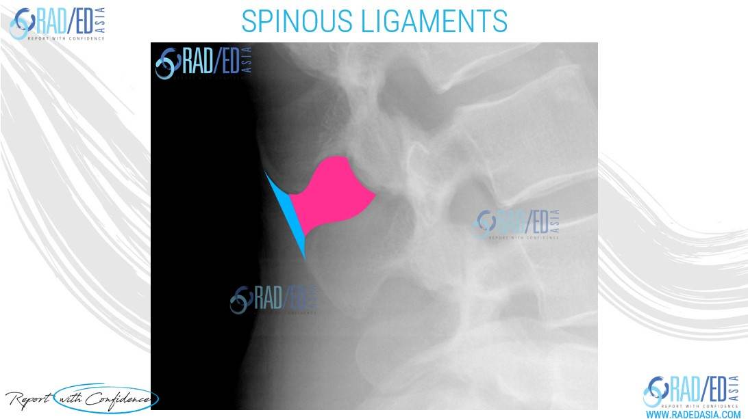 ankylosing spondylitis spinous ligaments imaging radiology xray ct mri