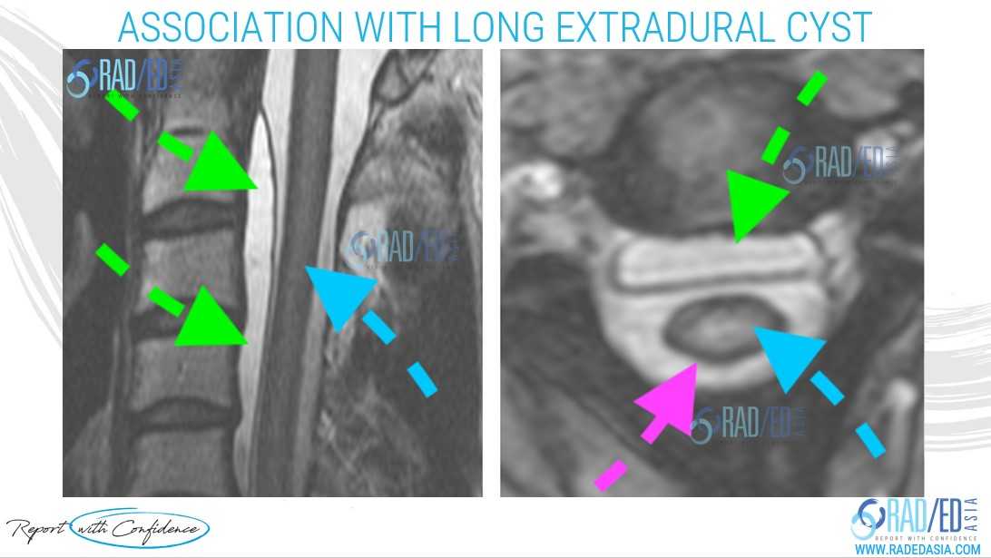 superficial siderosis mri arachnoid cyst extradural radedasia