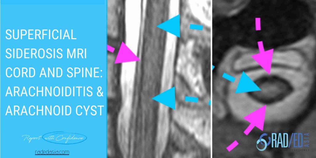 superficial siderosis mri arachnoiditis arachmoid cyst radedasia