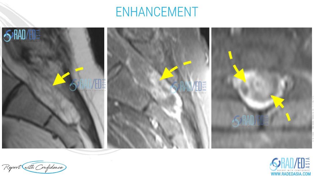 superficial siderosis mri arachnoiditis enhancement radedasia