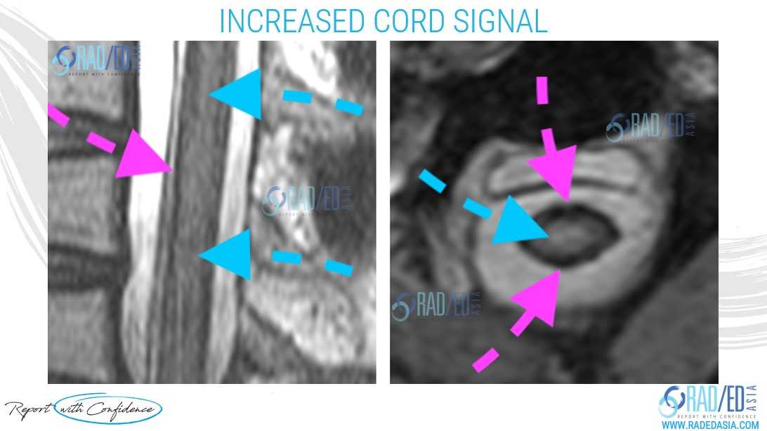 superficial siderosis mri cord oedema radedasia