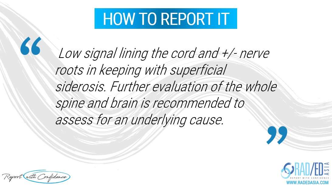 superficial siderosis mri nerve root cord spine report radedasia