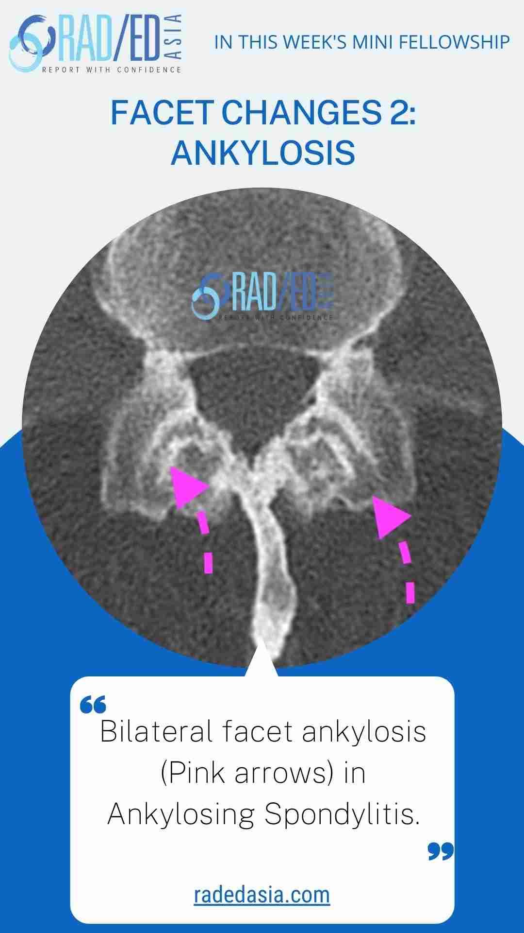 mri spine facet change ankylosis radedasia