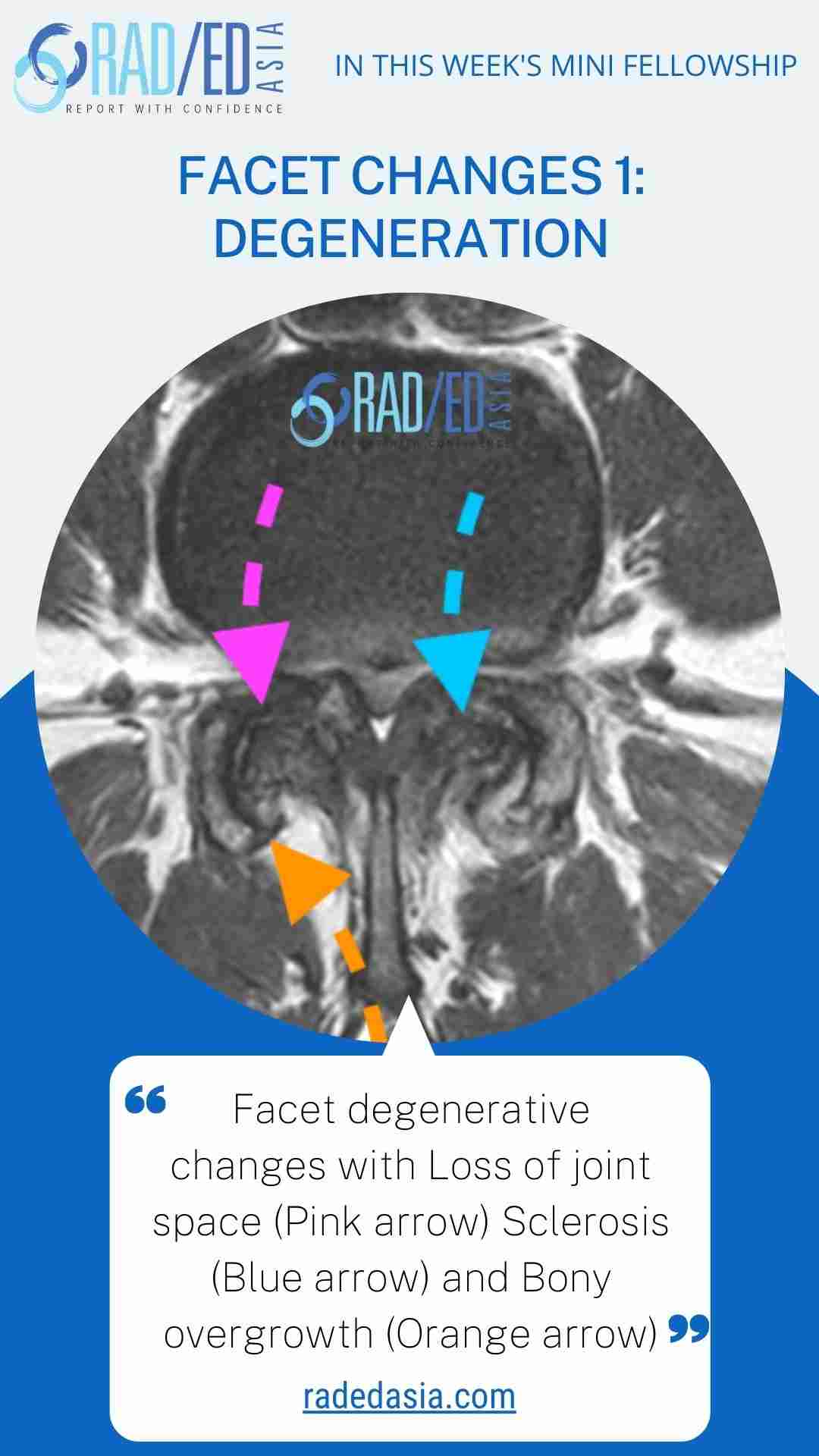 mri spine facet degen change radedasia