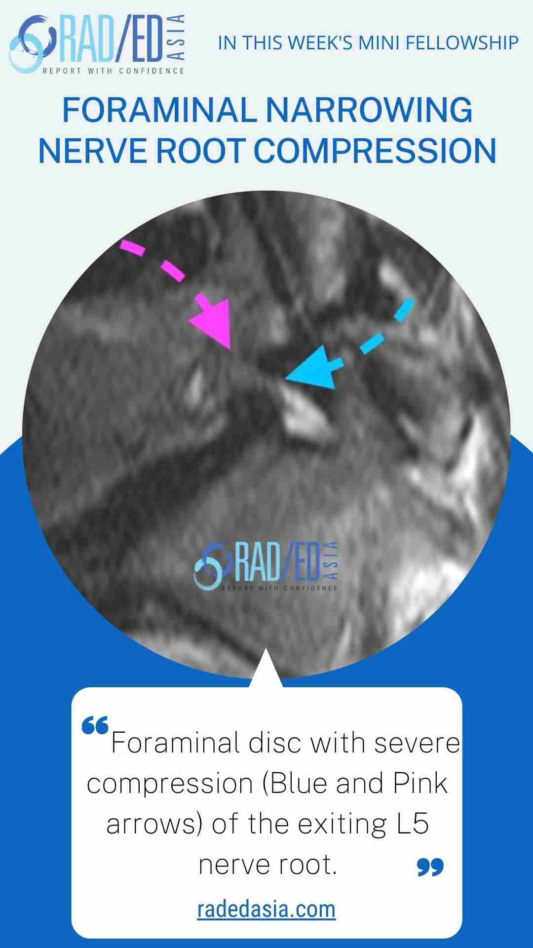 foraminal narrowing nerve root compression radedasia