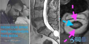 opll Ossification Posterior Longitudinal Ligament X-ray, CT, MRI spine mri online radiology course