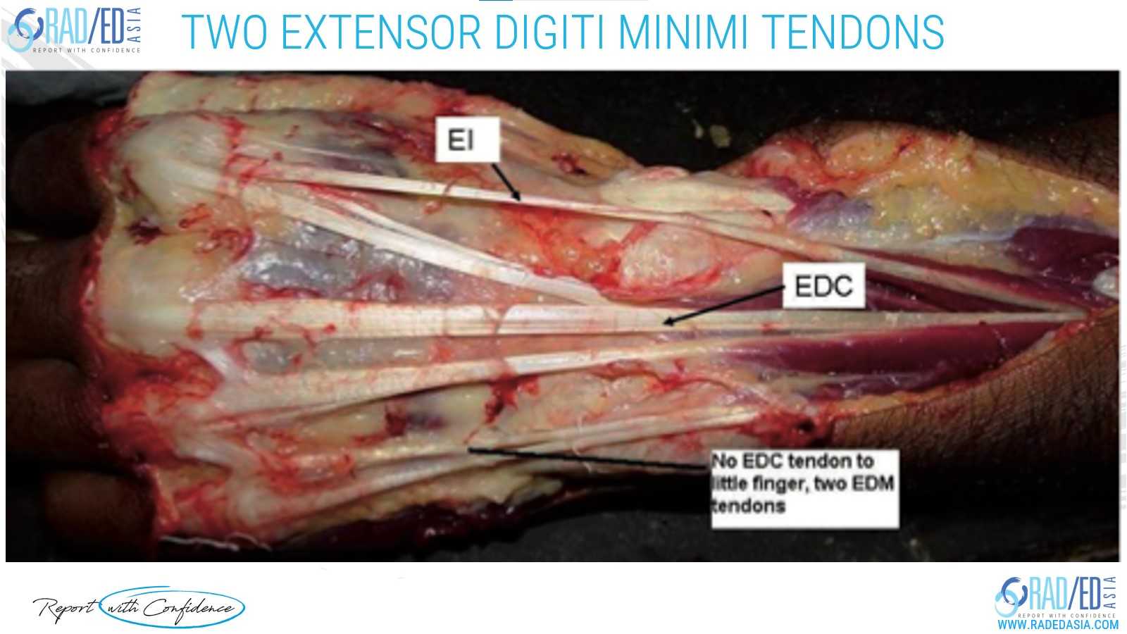 wrist anatomy two extensor digiti minimi tendons raadedasia