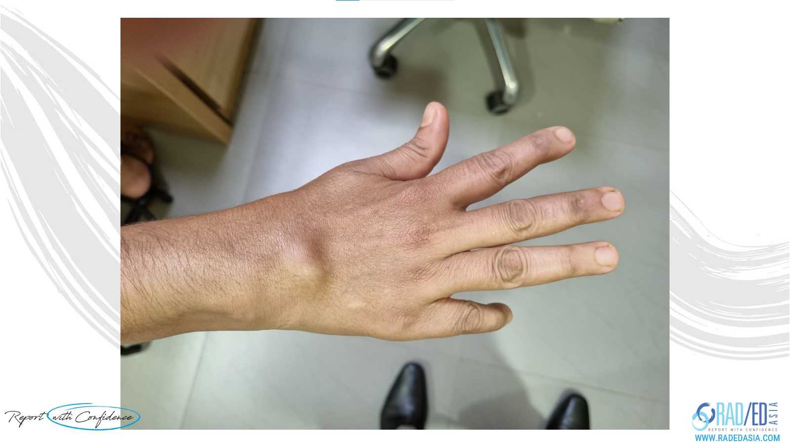 wrist rheumatoid arthritis Vaughn Jackson Syndrome finger clinical radedasia