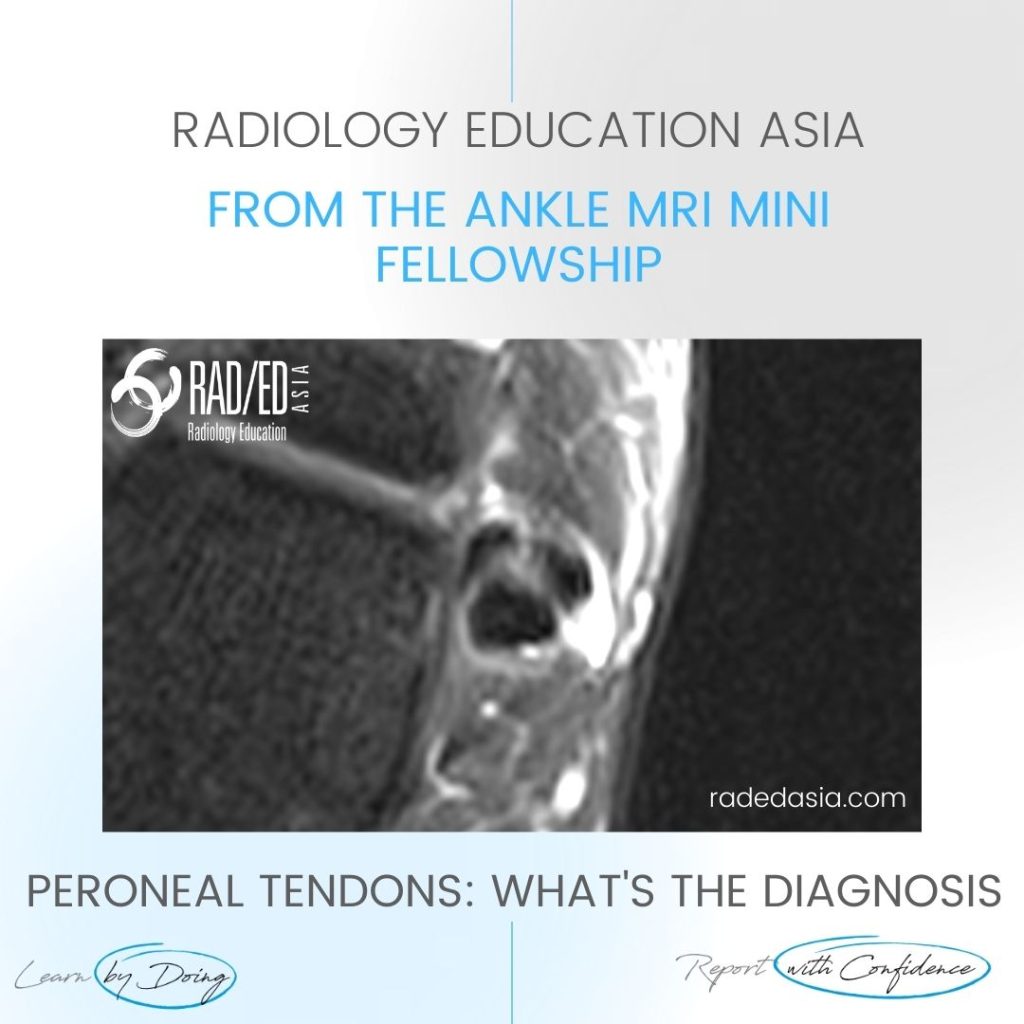 ankle mri peroneus brevis tendon tear split