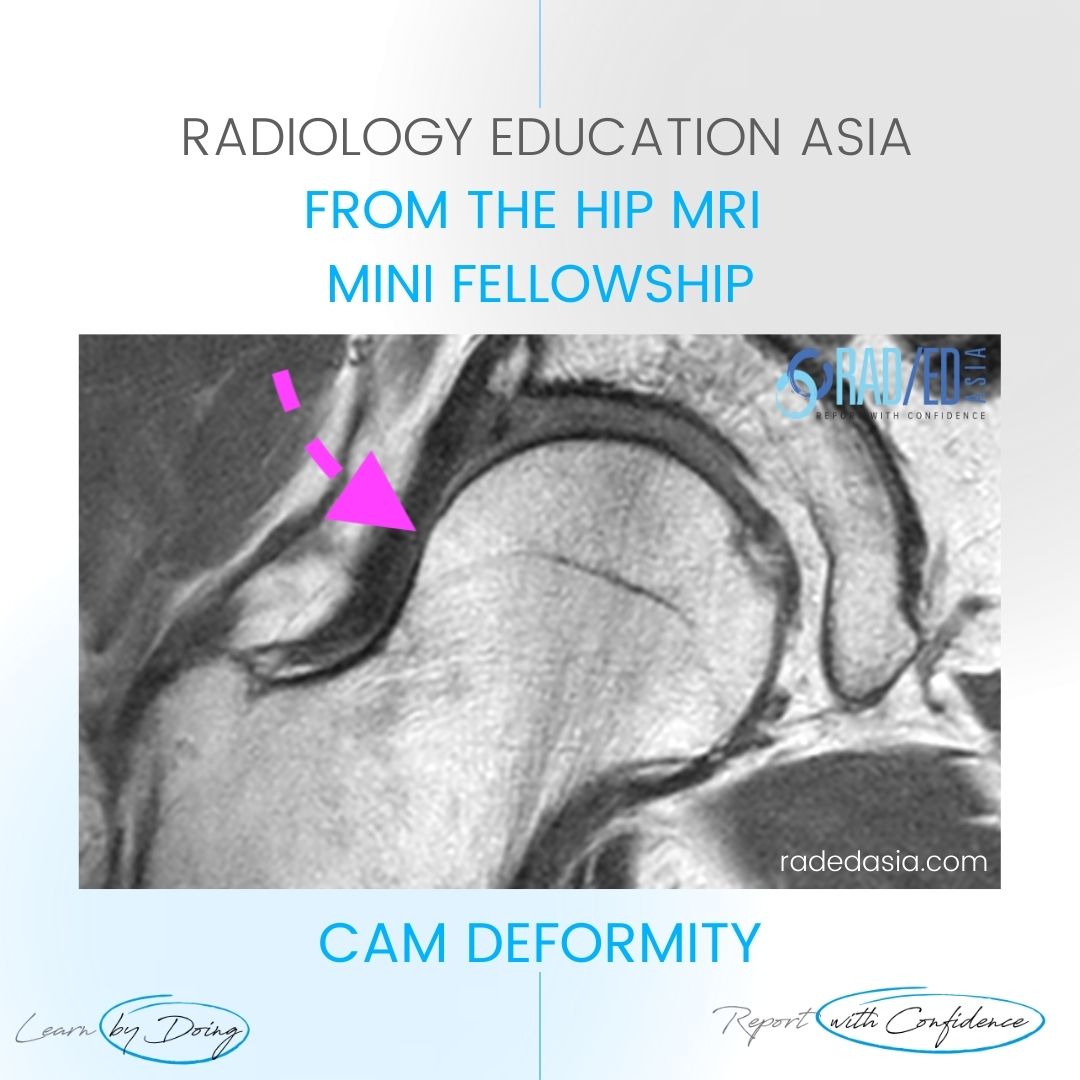 hip mri cam fai femoro acetabular impingement rea