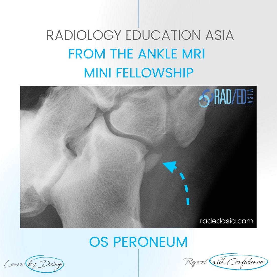 mri ankle os peroneum dx radedasia