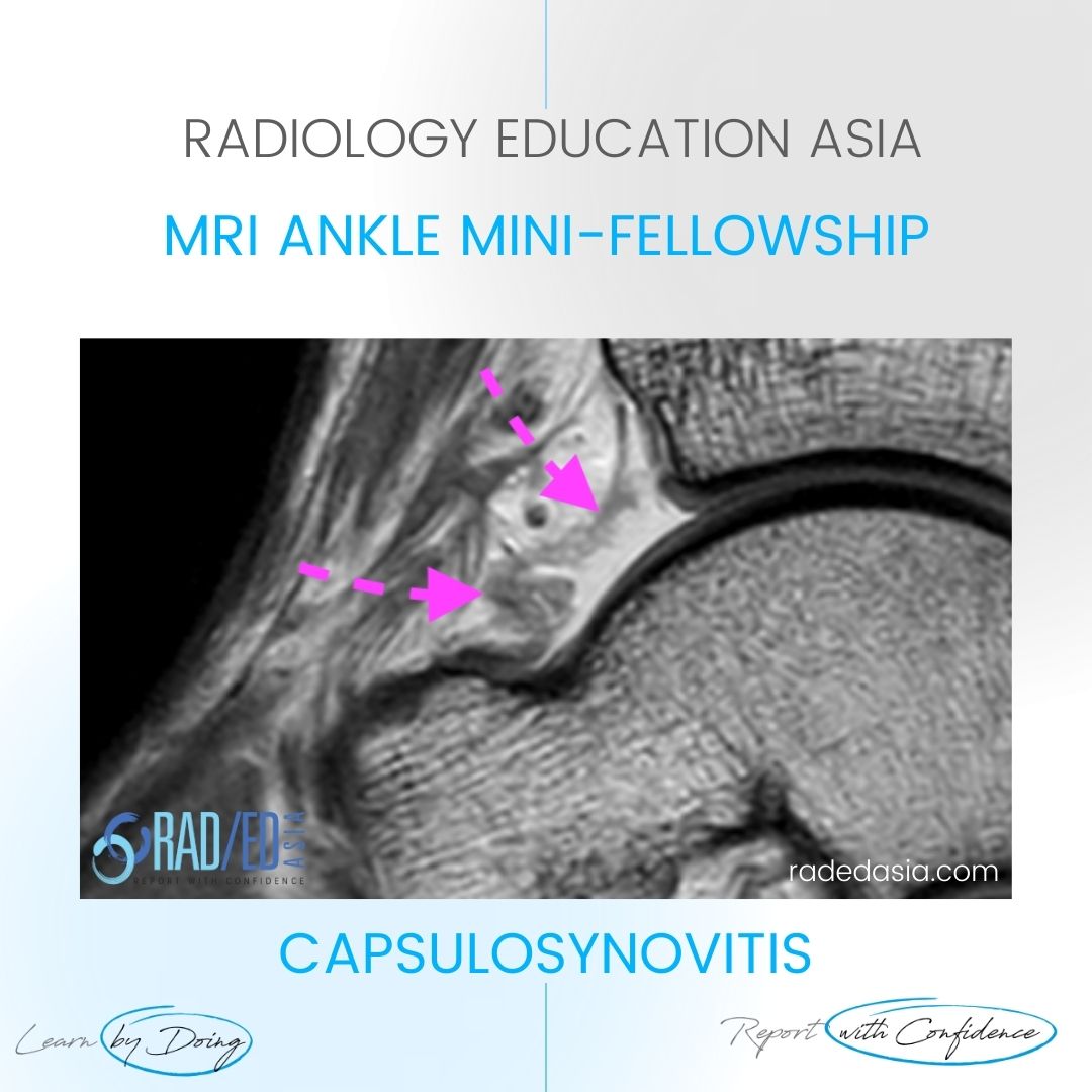 mri ankle synovitis capsulosynovitis