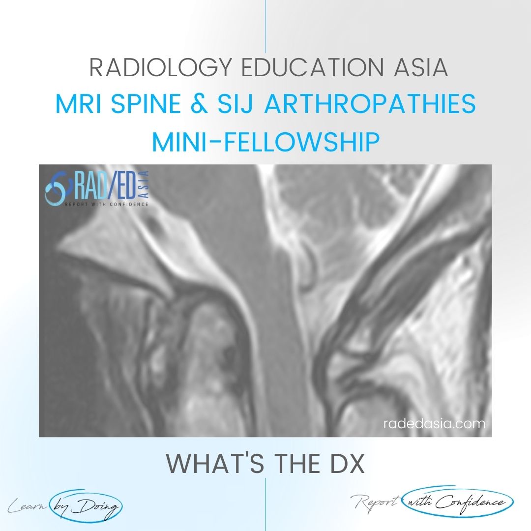 mri ct rheumatoid arthritis basilar invagination mcraes line wtd radedasia