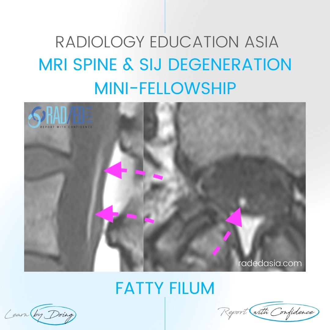 mri fatty filum learn spine radiology