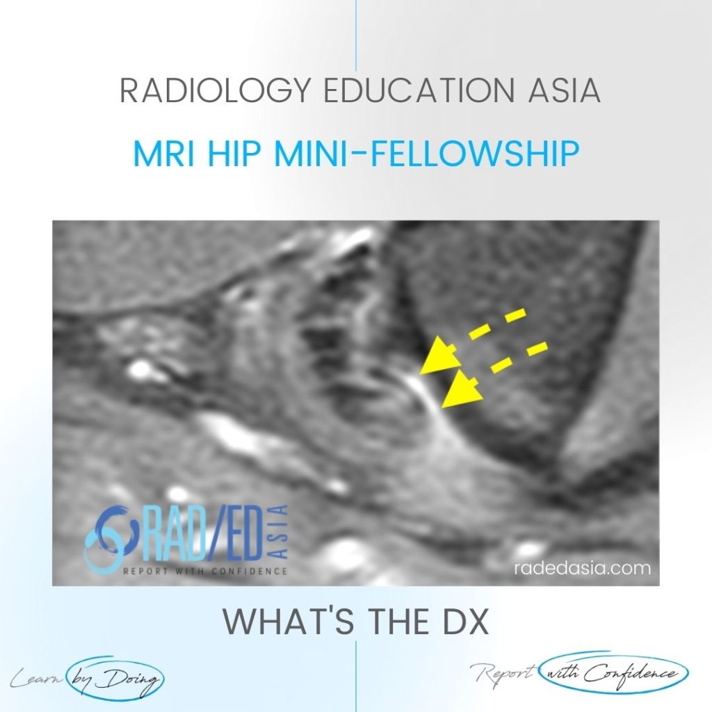 mri hamstring tear tendinopathy tendon hip