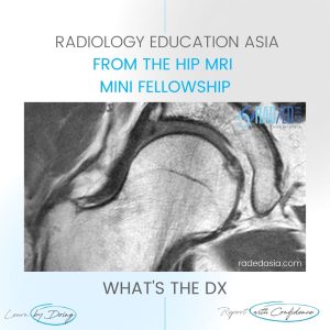 mri hip cam fai femoro acetabular impingement rea