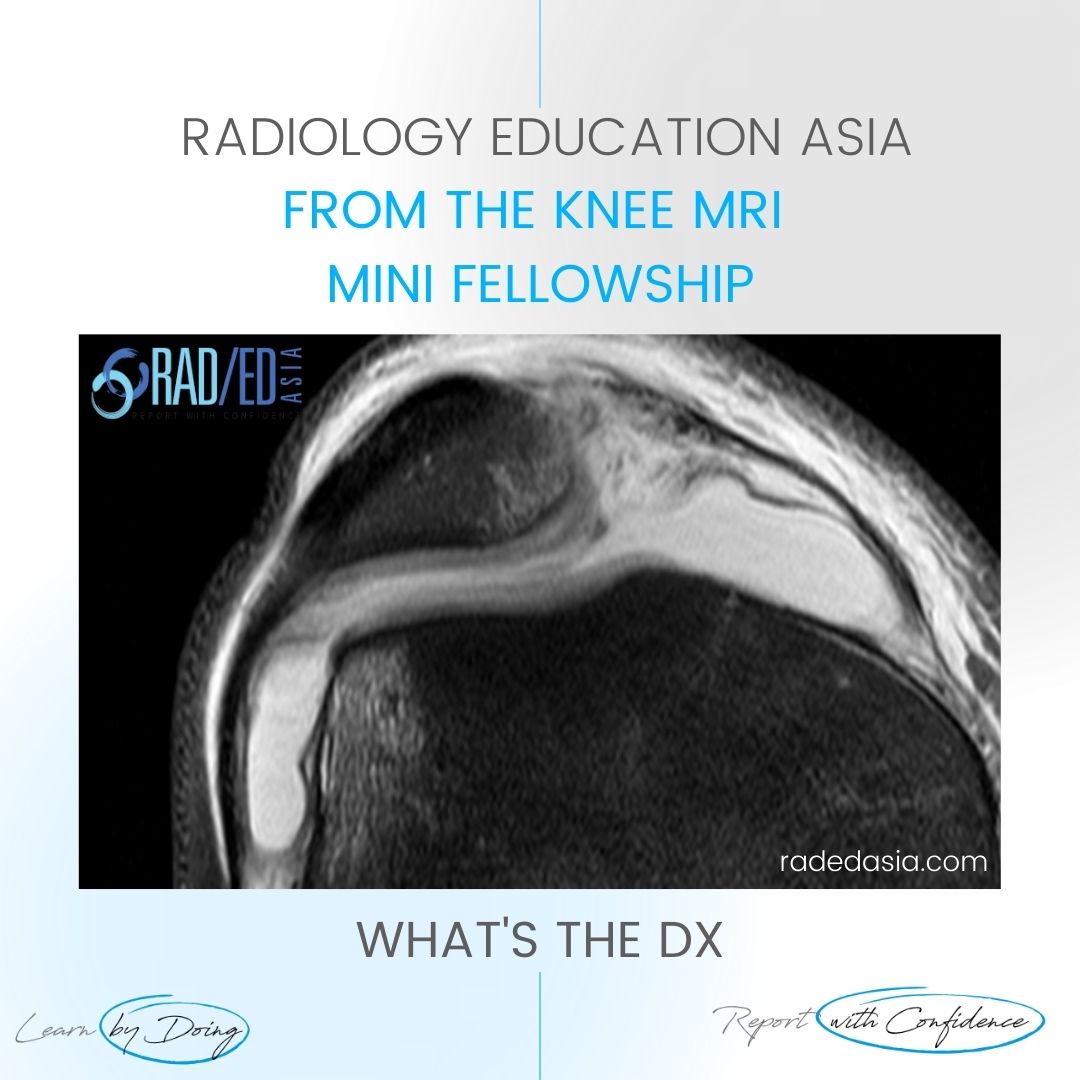 mri knee course patella dislocation