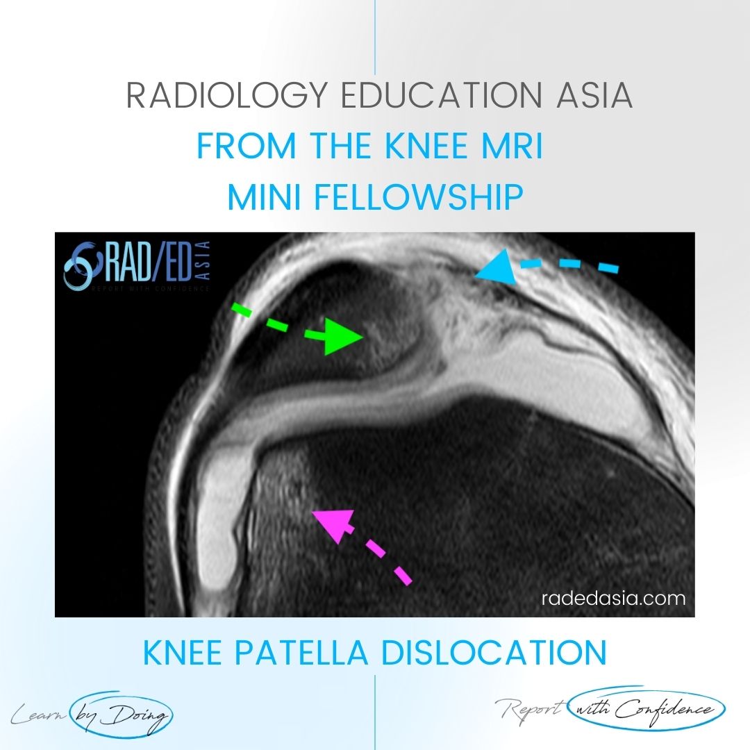 mri patella dislocation learn mri online dx