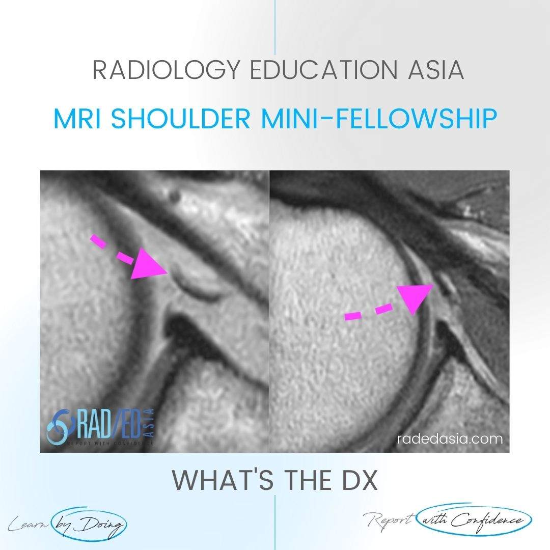 mri shoulder ligaments mghl middle glenohumeral ligament radedasia