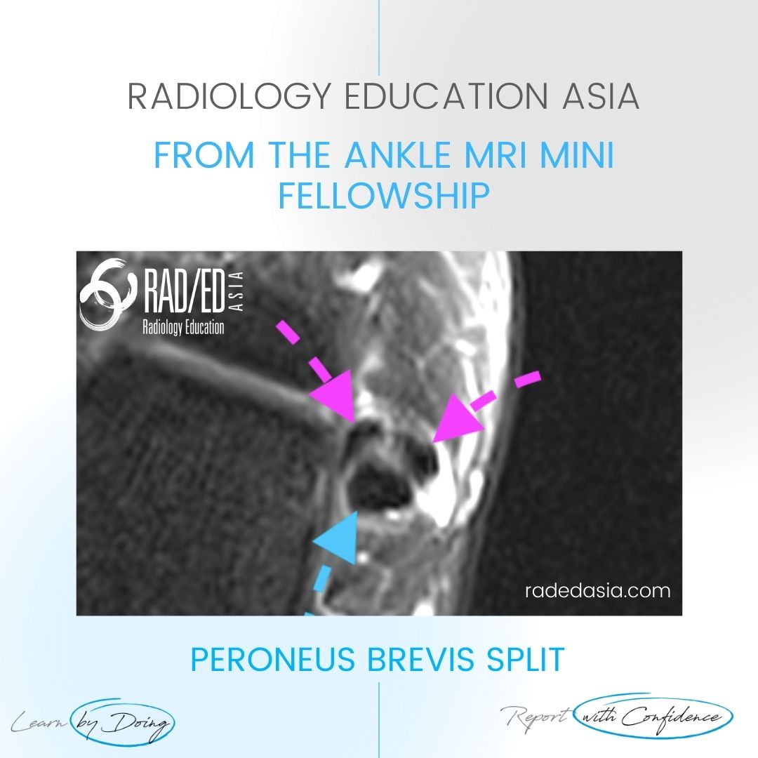 peroneus brevis tendon tear split ankle mri