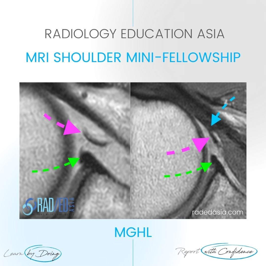 shoulder ligaments mri mghl middle glenohumeral ligament