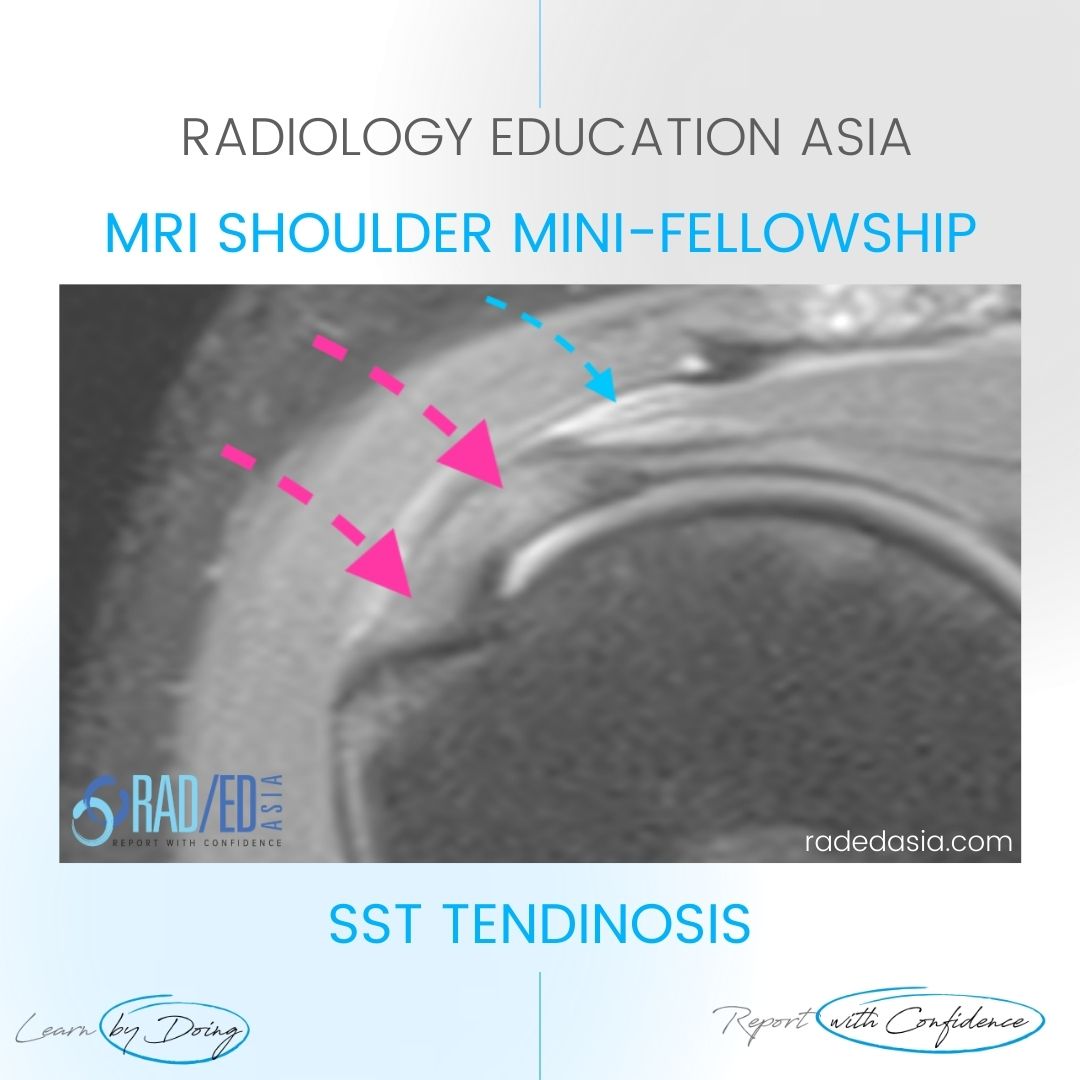 bursitis rotator cuff tendinitis mri supraspinatus tendinosis radiology