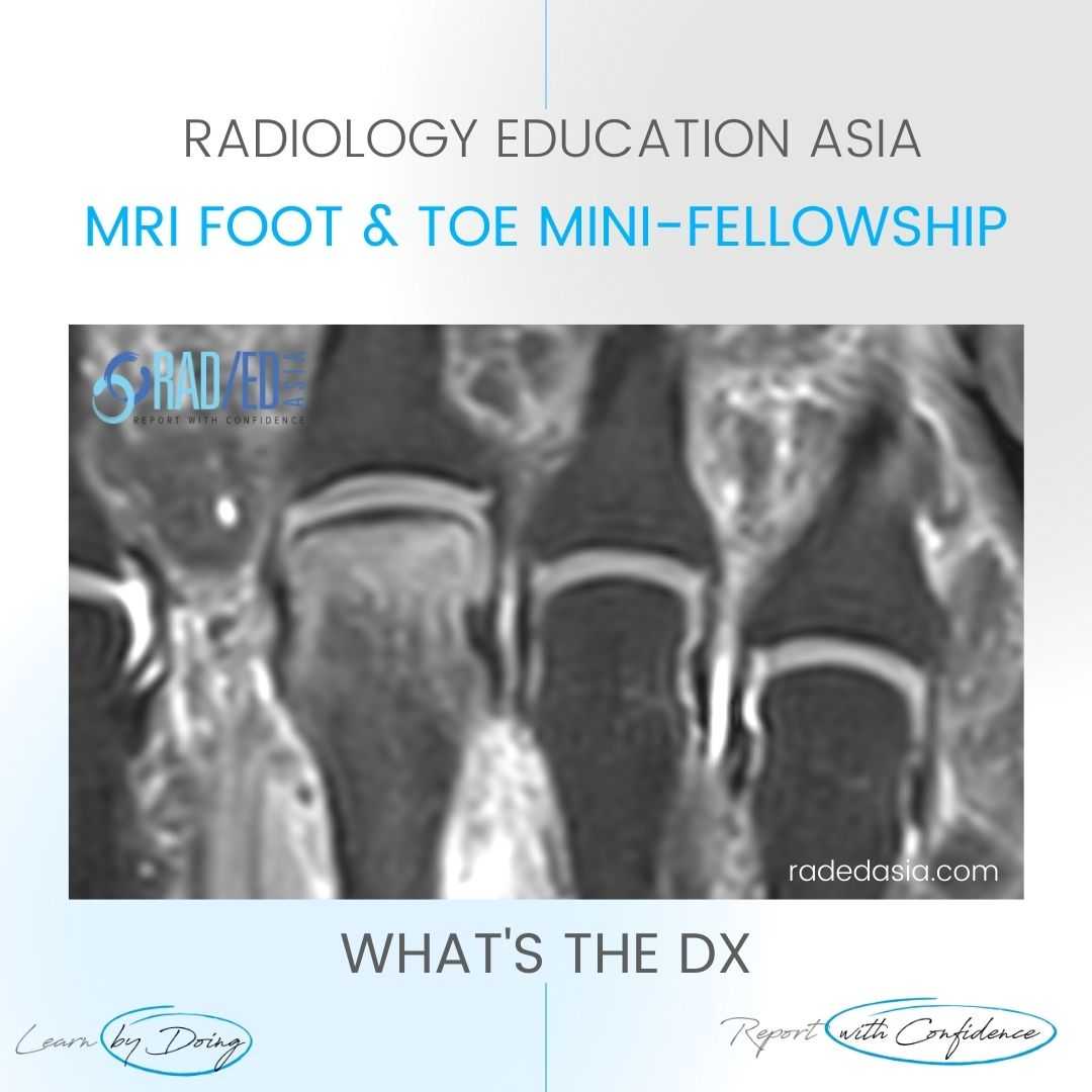 freiberg disease mri radiology toe radedasia