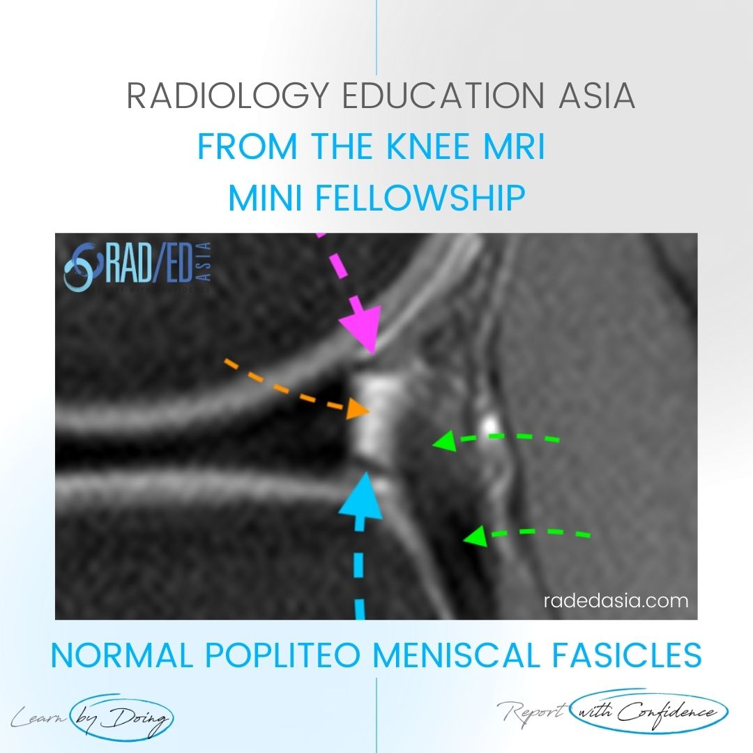 learn knee popliteomeniscal fasicles normal diag radedasia