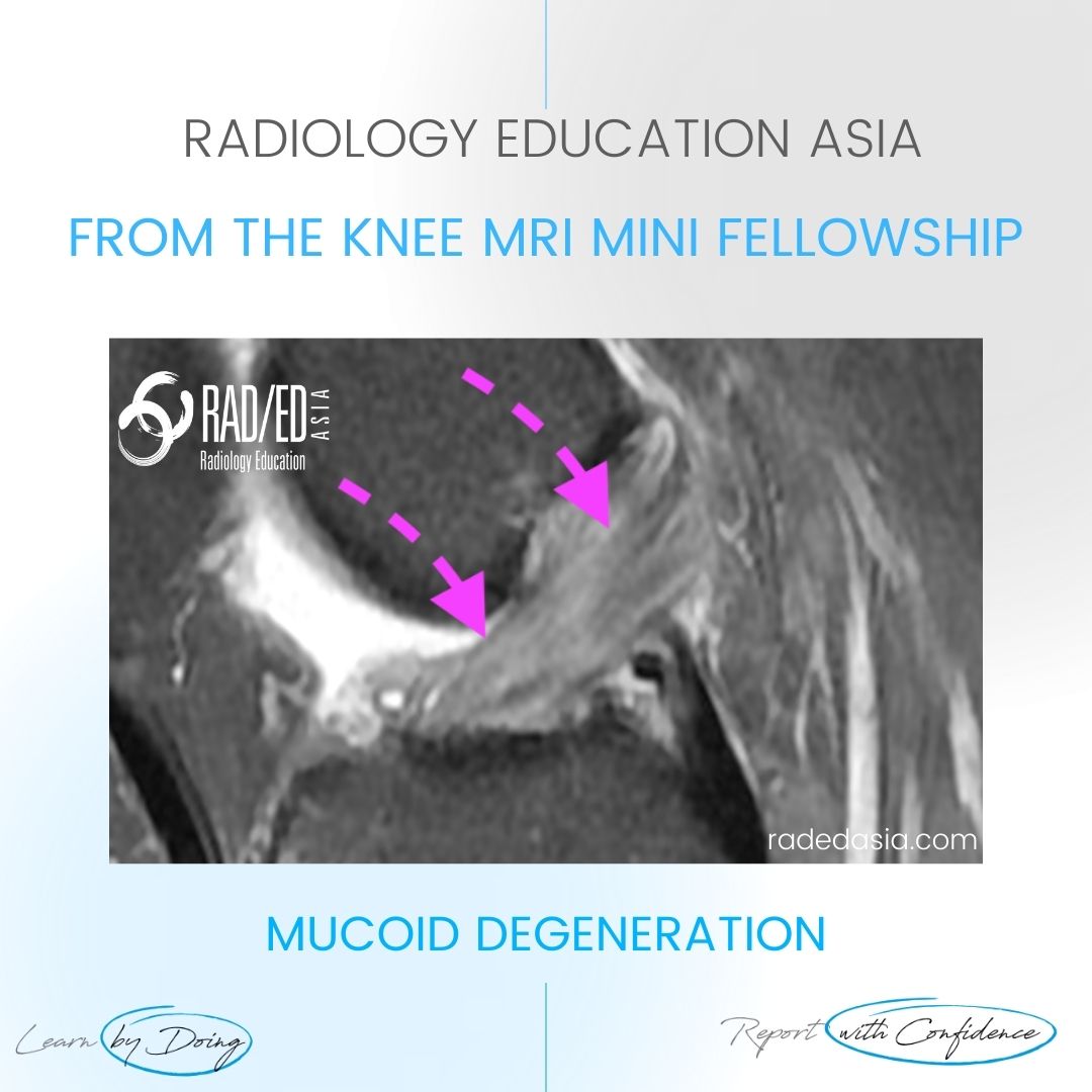 learn mri knee mucoid degen diag radedasia