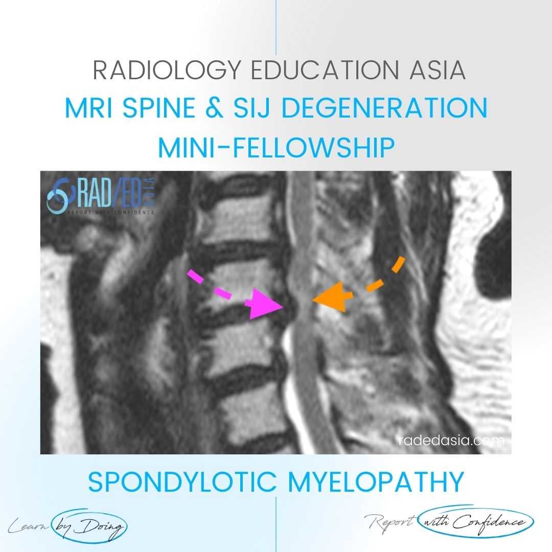 myelopathy mri spine cord signal change spondylotic