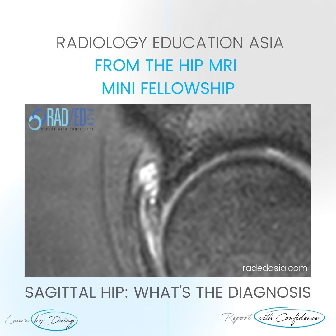 paralabral cyst learn hip labrum tear degeneration radedasia