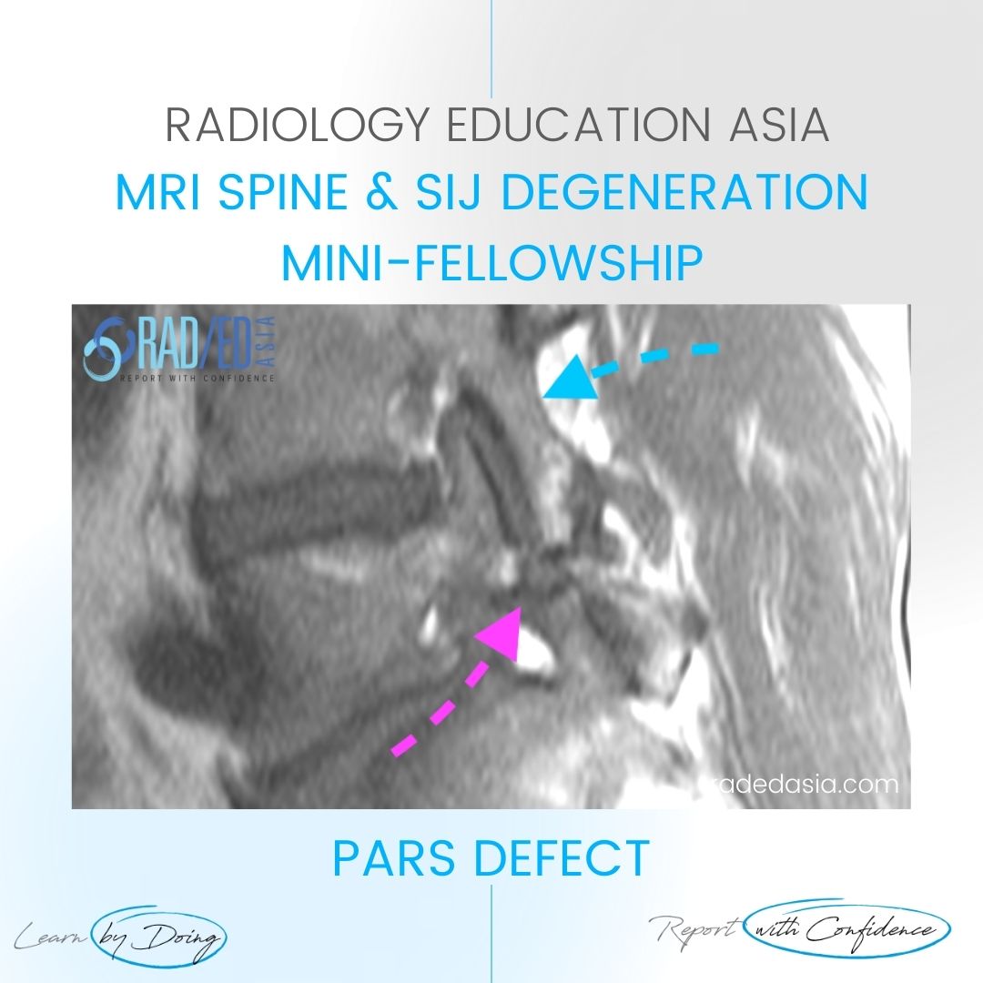 pars defect mri radiology radedasia