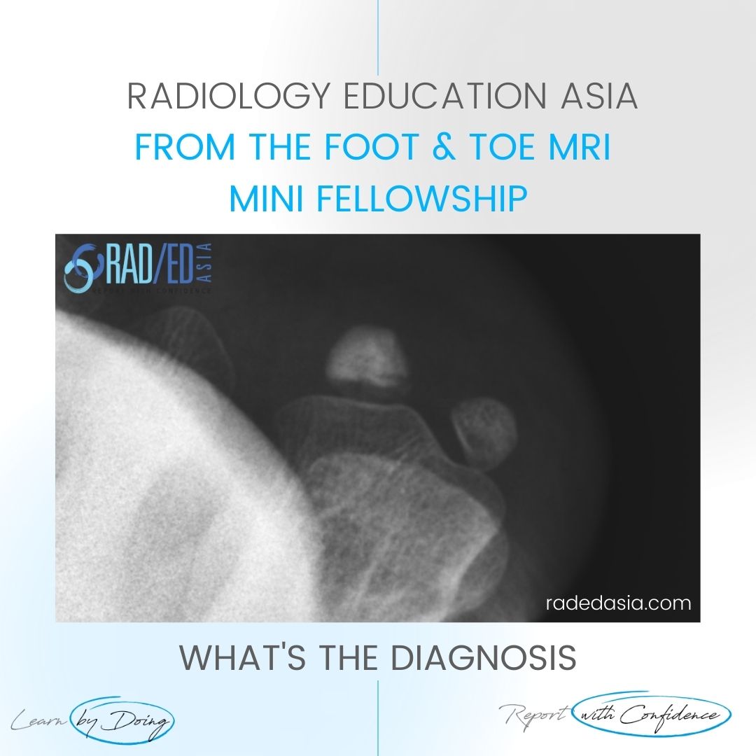 sesamoid osteonecrosis mri radiology