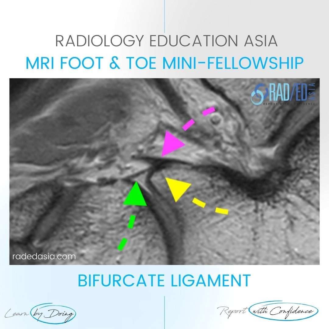 bifurcate ligament anterior process calcaneum radiology mri