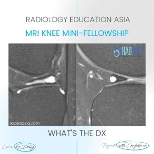 meniscus cyst radiology intrameniscal tear mri knee