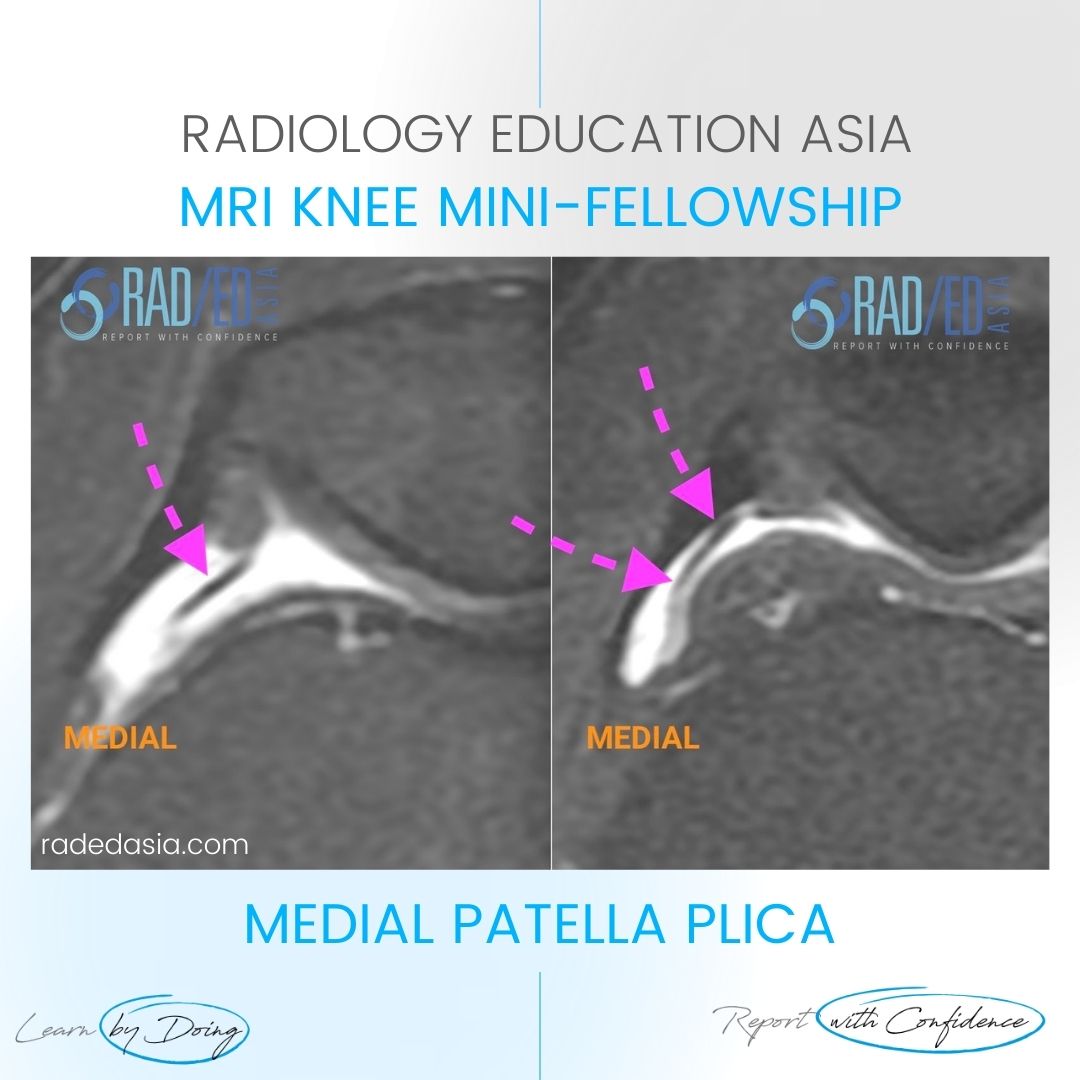 mri patella plica radiology syndrome knee medial radedasia