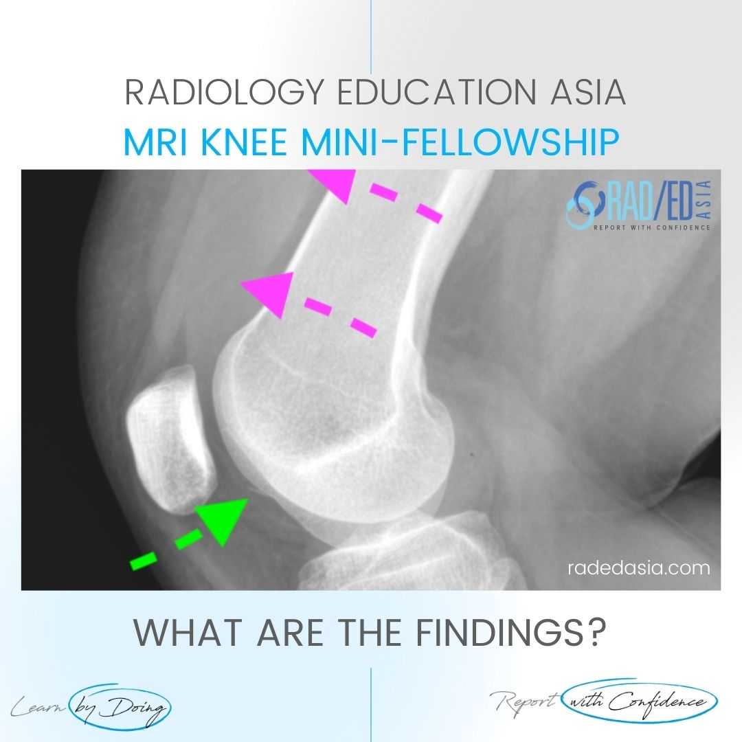 patella subluxation dislocation fracture hemarthrosis lipohemarthrosis radiology mri xray knee