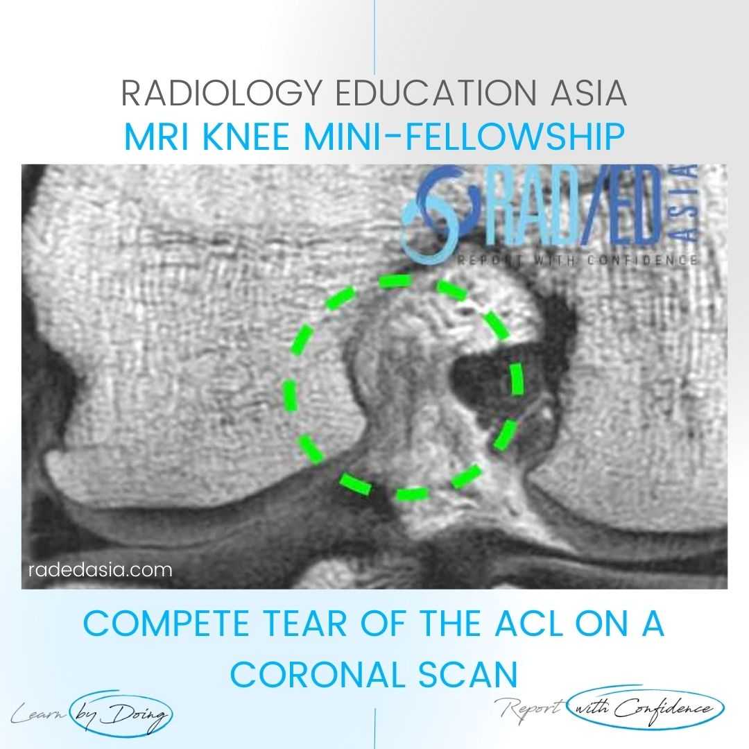 acl tear mri images findings knee full thickness coronal radiology radedasia