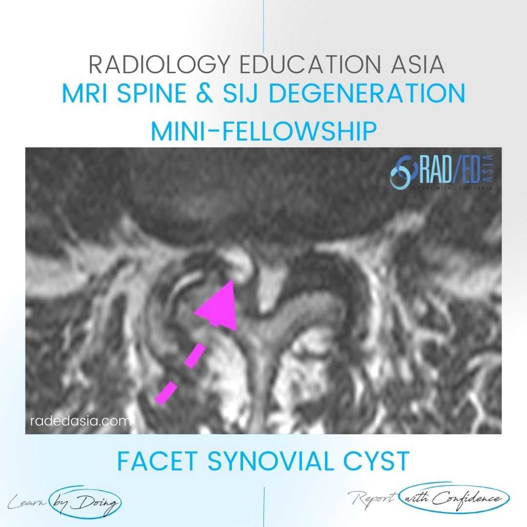 facet synovial cyst radiology mri lumbar spine