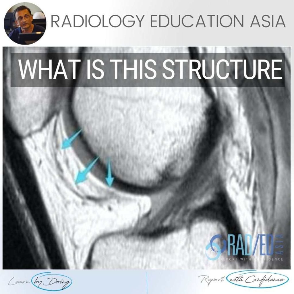 knee infrapatellar plica syndrome radiology mri radedasia